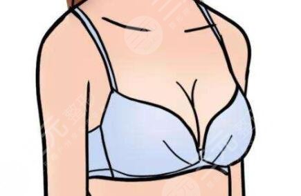 真人自体脂肪隆胸案例反馈