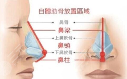 鼻部整形