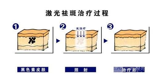 祛雀斑主要收费项目是什么?