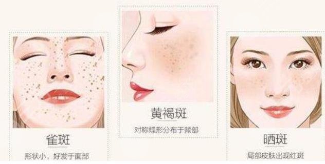 激光去雀斑安全吗?