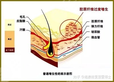 兰大二院疤痕修复图