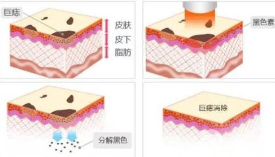 空军总医院整形美容中心点痣多少钱一颗?