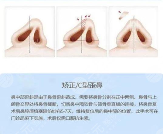 歪鼻矫正原理