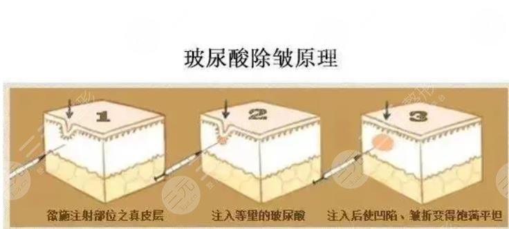 玻尿酸去鱼尾纹原理