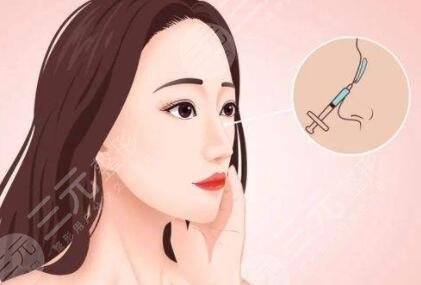 上海爱度医疗整形隆鼻案例