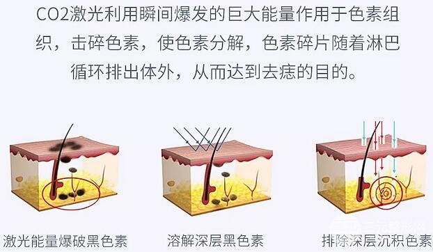 激光点痣