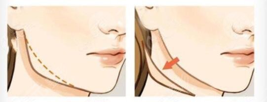 磨骨术后2个月