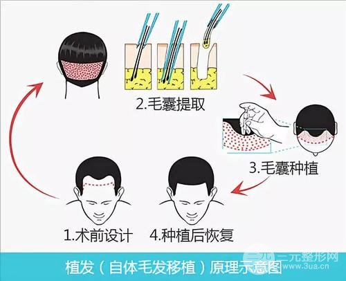 湘雅医院美容整形科皮肤科植发