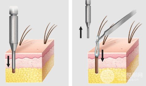 雍禾植发10元和20元的区别