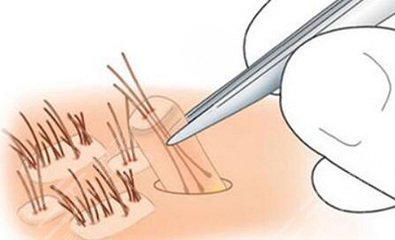 洛阳哪家医院可以植发