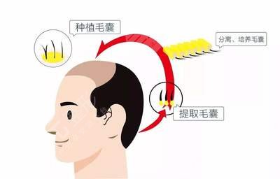 武汉市一医院植发疼吗