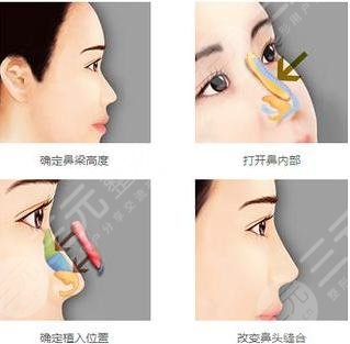 广医二院整形美容中心隆鼻原理