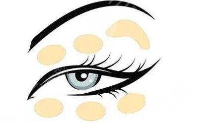 宝鸡人民医院整形美容科双眼皮案例果图：手术当天