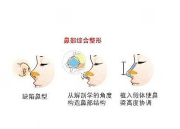 朱昕大夫鼻部手术整形介绍：