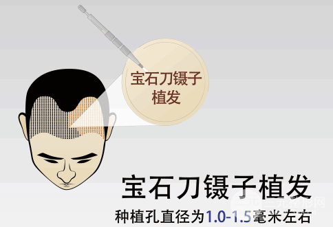 2020年度深圳植发医院排行