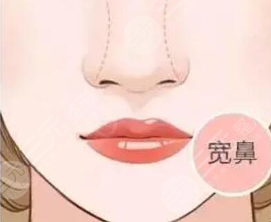 兰大二院隆鼻做得好吗?案例图