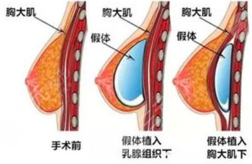 自贡第四人民医院整形科假体隆胸案例