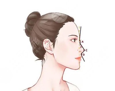 大庆天姿医疗整形田丽梅假体隆鼻案例