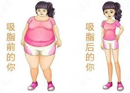 2024诸暨人民医院整形科价格表，大腿吸脂案例