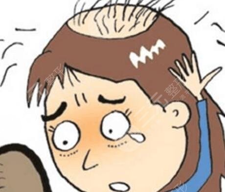 北京四惠中医院脂溢性脱发植发分享