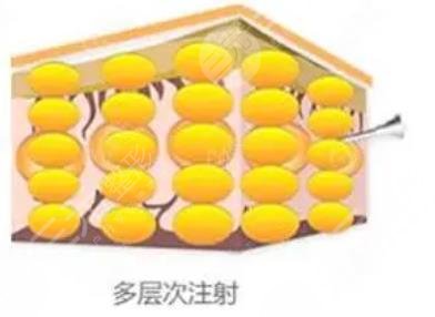 脂肪填充