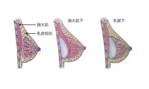 深圳美莱医疗美容整形医院隆胸特色项目：