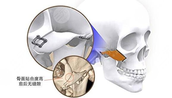 颧骨内推和果的根本区别