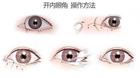成都三医院科室开眼角手术后32天