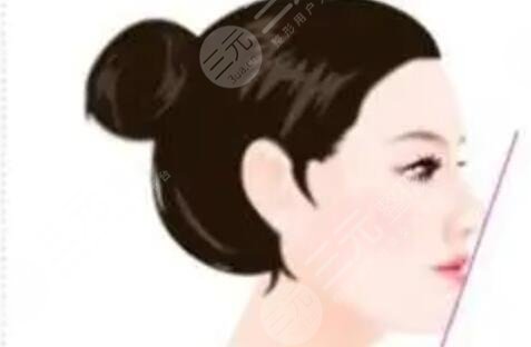 富拉尔基第一附属医院医美科隆鼻案例