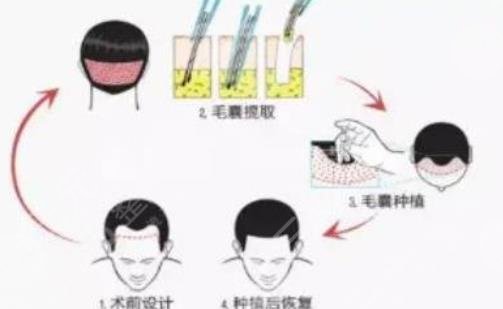 头发种植