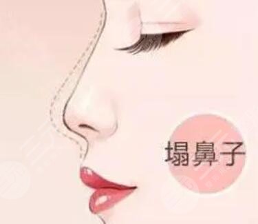 宝鸡市中心医院医美隆鼻手术