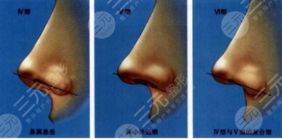 赵延勇鼻子案例
