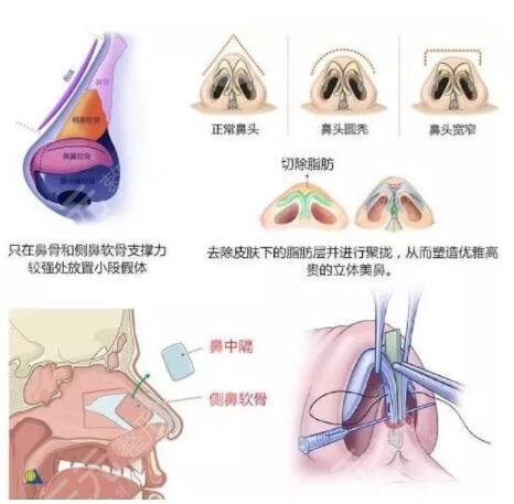 鼻部手术过程