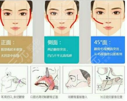 下颌角整形的优势有哪些?