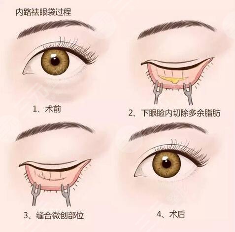 西京医院做眼袋成功案例