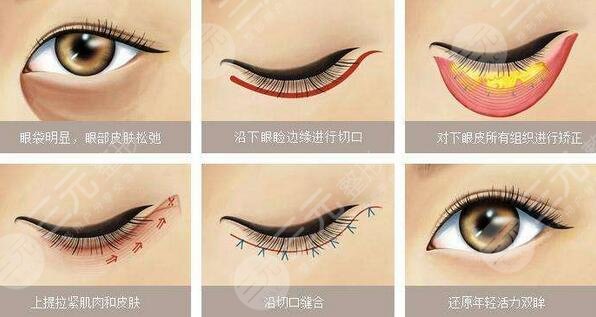 美立方整形医院去眼袋案例术前