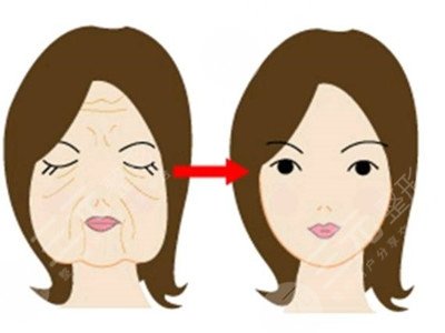 北京颐美佳中医院热玛吉案例