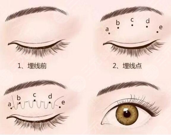 割双眼皮第一天