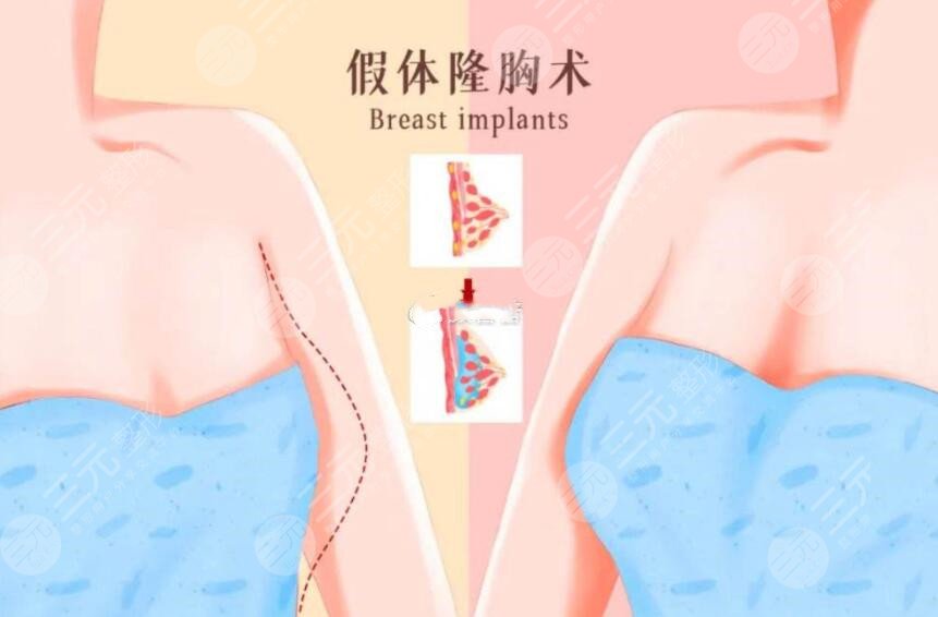 深圳美莱医疗美容医院隆胸特色项目