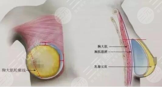 深圳美莱隆胸真人案例