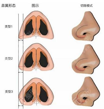 北京新美荟鼻翼缩小案例