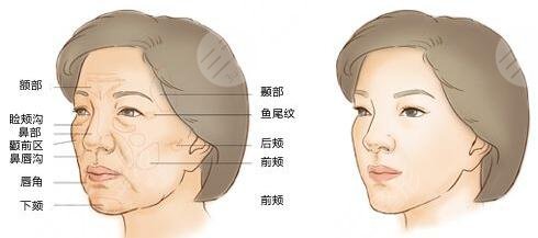 湘潭做面部脂肪填充案例
