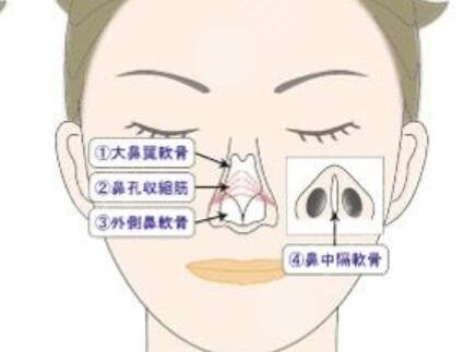 假体隆鼻手术之后