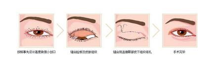 双眼皮失败修复示意图