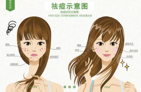 点阵激光案例