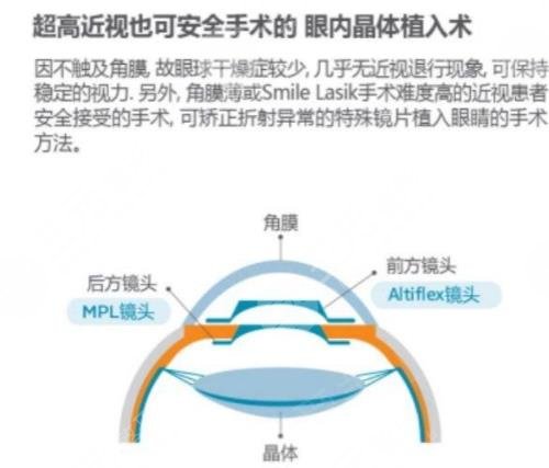 近视晶体手术案例过程
