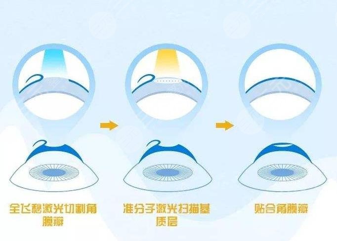 近视眼矫正过程