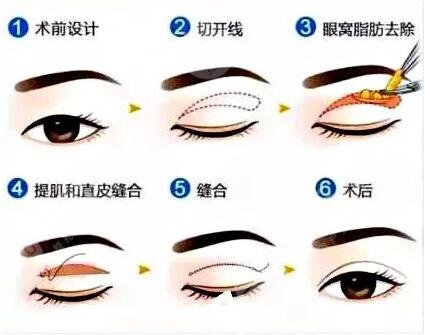 双眼皮手术案例