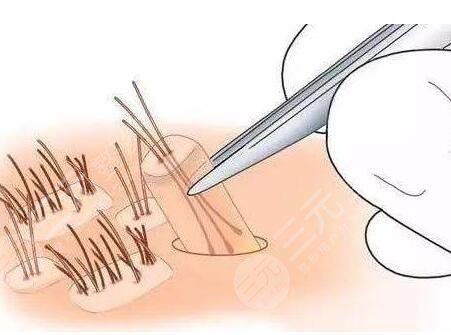 珠海植发真实果