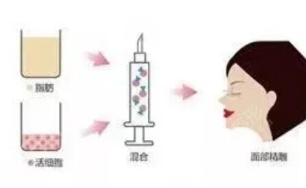 北京星颜医美自体脂肪填充面部案例